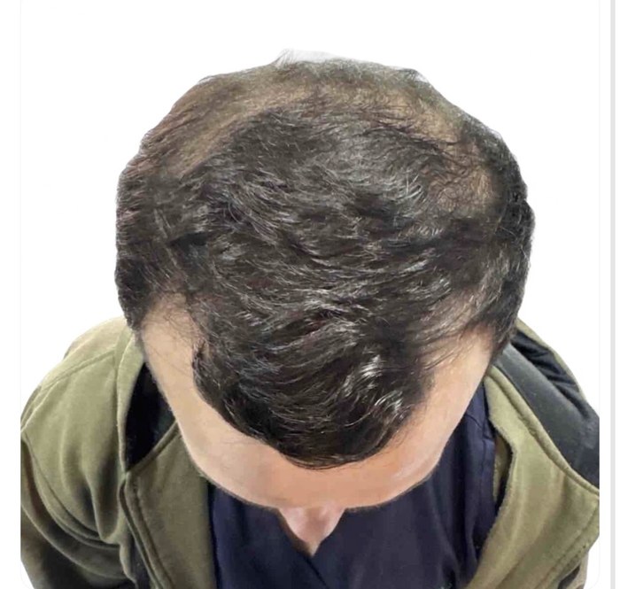 Antes do transplante capilar - caso 2