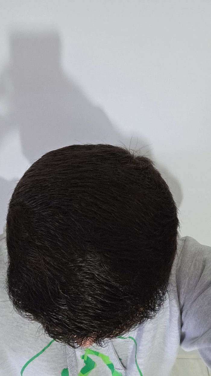Depois do transplante capilar - caso 2